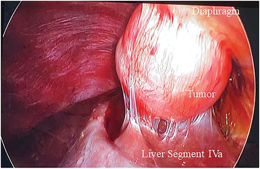 Metastatic endometrial stromal sarcoma tethered to the right diaphragm and segment IVa of the liver.