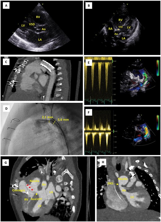 Imaging findings. (A) Parasternal long-axis echo view on postnatal Day 0, showing the large VSD and narrow native LVOT (5.0 mm in this view). (B) Apical five chamber echo view on postnatal Day 0, showing posterior displacement of the conal septum (*) and the narrow native LVOT (3.7 mm in this view). (C) CTA scans after first cardiac catheterization at the age of 12 days, showing position of the ductal stent. (D) Emergency cardiac catheterization at the age of 2 months, showing restenosis of the (non-stented part of the) proximal duct (30 mmHg, diameter 2.1 mm). (E, F) Pulsed wave Doppler evaluation of ductal flow, showing flow acceleration up to 2.5 m/s when the patient was stabilized at the PICU prior to emergency cardiac catheterization (E) and reduction of this flow acceleration to <1.5 m/s following resolution of the stenosis using a Formula 535 vascular balloon-expandable stent (F). (G, H) CTA scan after Yasui procedure; modified views to demonstrate the Rastelli tunnel (red arrows) and the narrow native aortic valve (Ao) (G) as well as the DKS anastomosis (H). Ao, aorta; CTA, computerized tomography angiography; DKS, Damus–Kaye–Stansel; LA, left atrium; LV, left ventricle; PICU, pediatric intensive care unit; NeoAo, neo-aorta; RA, right atrium; RV, right ventricle; VSD, ventricular septal defect.