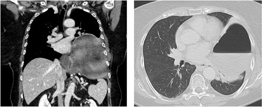 Chest/abdomen computed tomography showing a new recurrence with complete up-side-down stomach and compression of the left lower lung lobe.