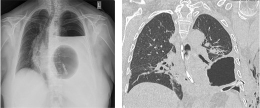 Chest X-ray showing a large left-sided tension seropneumothorax with a right-sided mediastinal shift. Chest CT-scan after insertion of a chest tube.