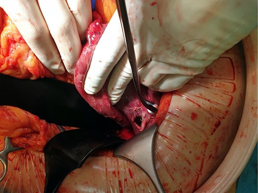Intraoperative finding with the gastric perforation.