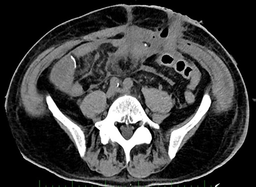 Post-operative Day 14. Abdominal CT-scan with free intraperitoneal fluid, without sign of ileus, perforation or anastomosis release.