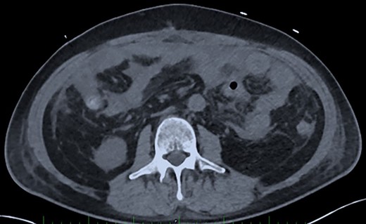 Post-operative Day 20. Abdominal CT-scan with free intraperitoneal fluid, without sign of ileus, perforation or anastomosis release.