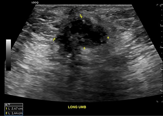 Abdominal ultrasound demonstrates a 2.5 x 1.4 x 1.4 cm complex solid and cystic mass at the umbilicus suspicious for trocar-site endometrioma.