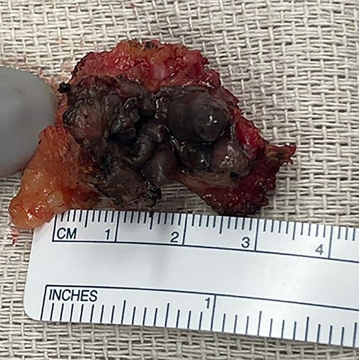 Surgical resection of umbilical lesion with visualization of dark-colored cystic implants. Pathology confirmed diagnosis of endometriosis.