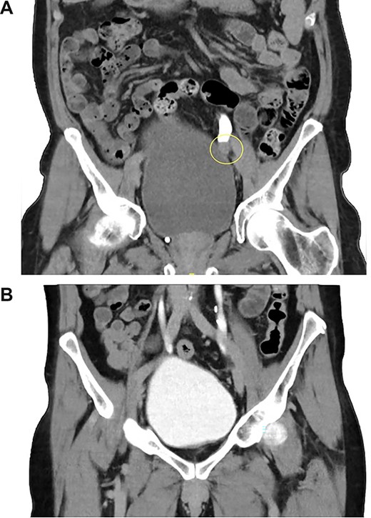 (A, B) CT-IVP before the surgical excision and 6-month post-operation.