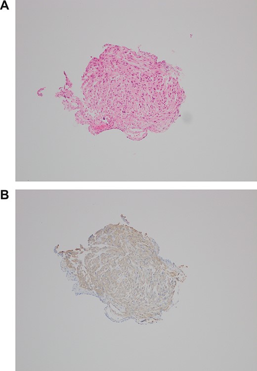(A, B) H&E biopsy × 100 and SMA IHC—small fragment of tissue with elongate cells and moderate nuclear pleomorphism. Flattened lining could be urothelium (lower left corner). Positive for smooth muscle antigen on immunohistochemistry, consistent with leiomyosarcoma.