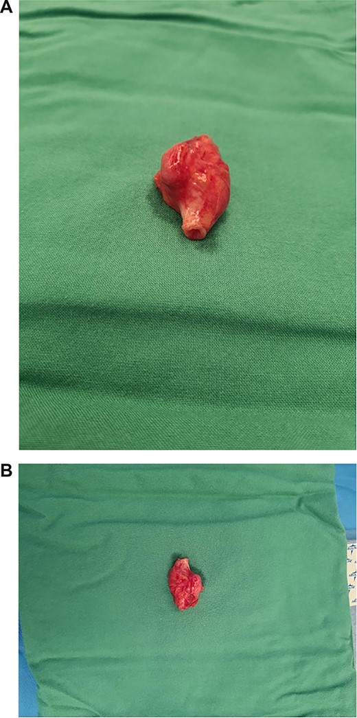(A, B) Macroscopic views of resected ureteric leiomyosarcoma mass.
