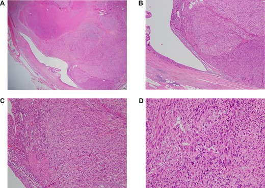 (A–D) H&E resection ×12.5, ×40, ×100 and ×200—ureteric lumen (left of picture) lined by stratified, transitional epithelium, with high grade leiomyosarcoma extending from the wall. Note the spindled appearance of the lesional cells, with marked nuclear atypia and mitotic activity. In the lowest magnification (×12.5), the area of necrosis is the ill-defined pink region in the top left hand corner.