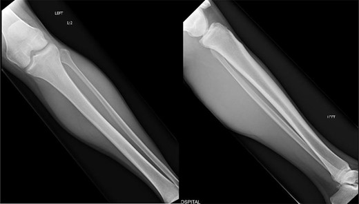 Orthogonal radiographic views of the patients left tibia and fibula. No evidence of trauma to be suspected which correlated with the patient’s history.