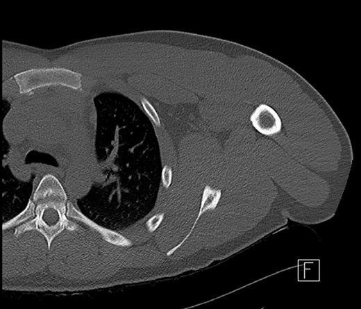 CT scan of left shoulder with no significant soft tissue or mediastinal abnormality.