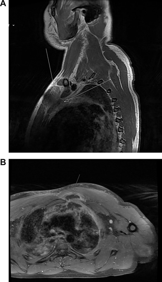 (A) Post-contrast MRI scan showing areas enhancement around pectoralis major (myositis) with extension into the mediastinum (mediastinitis) (white arrows). (B) New rim-enhancing collections within left pectoralis major muscle. The collection appears to extend posteriorly into the anterosuperior mediastinum (white arrows)