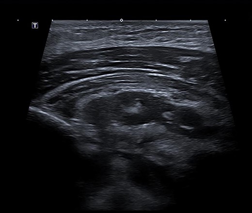 Ultrasound scan demonstrating a retropectoral abscess communicating with the mediastinum.