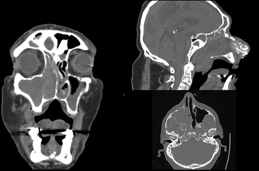 Initial CT scan of the head and neck region in coronal, axial and sagittal view show expansive formation predominantly in the right half of the paranasal sinuses. Right maxillary sinus is completely filled with tumor mass as well as right nasal cavity with infiltration of the septum, all ethmoid cells and the frontal sinus through frontoethmoid recess. Sagittal view show tumor spread in the nasopharynx.