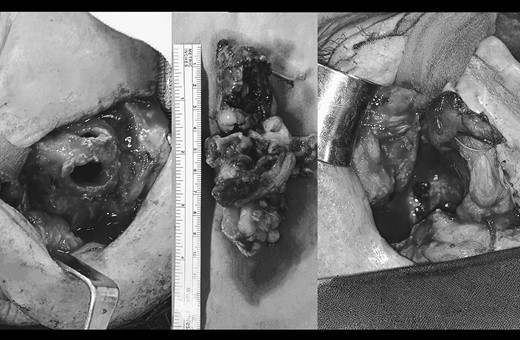 Surgical resection of the tumor by mid-face degloving approach (left).The tumor extended from the lateral wall of the maxillary sinus to the anterior part of the inferior nasal turbinate up to 5 cm below the epipharynx into the oropharynx. Antero-posterior size of the tumor mass was 10 cm. (middle). Surrounding margins were free of tumor cells on the intraoperative frozen section.
