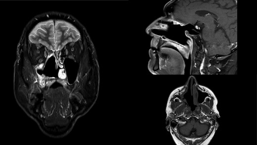 MR scan in coronal, sagittal and axial view on control 14 months postoperatively. Right nasal cavity and right maxillar sinus and ethmoid widely open free of tumor.