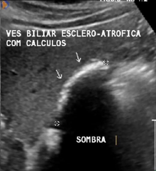 AUS showing a contracted and shrunken gallbladder with gallstones (arrows).