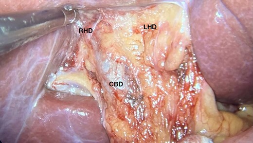 Image showing the gallbladder anatomical site and hepatic hilum without normal nor shrunken gallbladder; CBD, common bile duct; RHD, right hepatic duct; LHD, left hepatic duct.