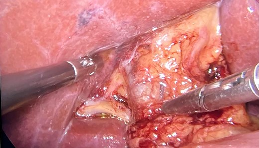 Image showing the hepatic hilum during surgery.