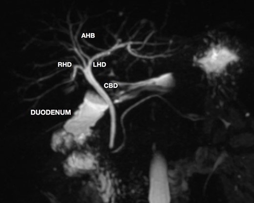 MRCP showing biliary tract with GA and no other biliary anomaly; duodenum and the main pancreatic duct are also with visibility; AHB, anterior hepatic branch.