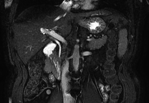 MRCP coronal image showing the common bile duct, portal vein, duodenum, liver and other close structures; there is no sign of gallbladder.