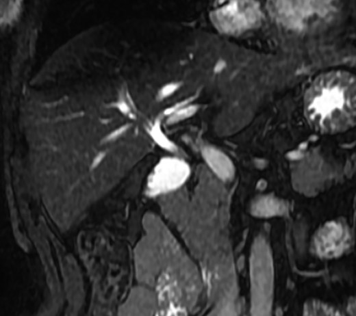 MRCP coronal image showing the intrahepatic biliary tract, with good vision of common bile duct, right and left hepatic ducts and anterior branch duct.