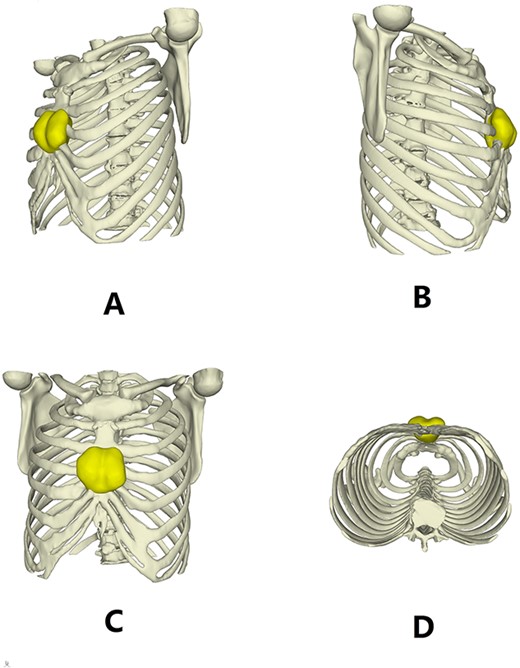 Three dimensional reconstruction images of the chest wall.