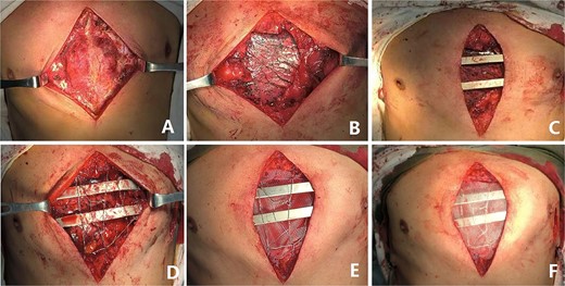 (A) Exposing tumor; (B) Resection of tumor; (C) Complete Wenlin procedure with two steel bars; (D) Wires mesh; (E), Fiber membrane is placed inside the steel bars and (F) The fiber membrane is placed outside the steel bars.
