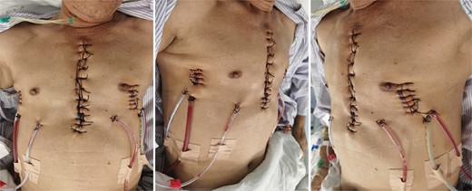 Appearance of chest wall after operation.