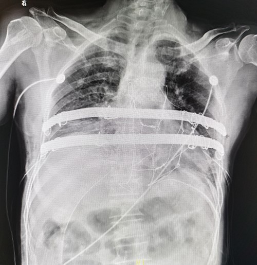 Postoperative X-ray examination.