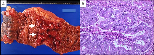 (A) Gross appearance of the resected portion of the rectum. A Type 2 tumor (white arrows) is seen. (B) Microscopic examination revealed well-differentiated adenocarcinoma (hematoxylin and eosin stain; original magnification, ×200).