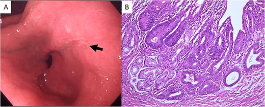 (A) Upper gastrointestinal endoscopy showed a depressed lesion (black arrow) in the posterior wall of the antrum. (B) Microscopic examination revealed proliferation of atypical cells forming irregular tubular structures (hematoxylin and eosin stain; original magnification, ×100).