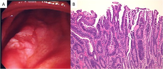 (A) Endoscopic appearance of the duodenal lesion. A IIa + IIc lesion is seen. (B) Microscopically, a well-differentiated adenocarcinoma is seen (hematoxylin and eosin stain; original magnification, ×100).