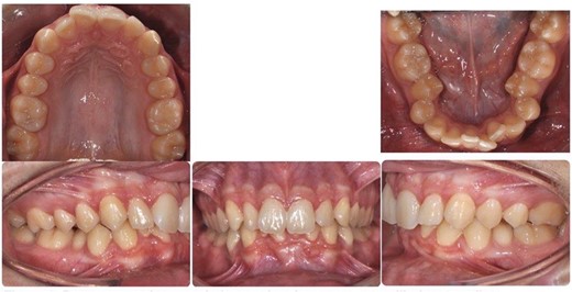 Pretreatment intra-oral photos showing severe mandibular crowding.