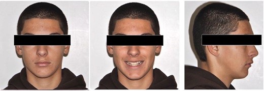 Pretreatment extra-oral photos.