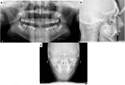 (a) Pretreatment panoramic radiograph; (b) pretreatment lateral cephalometric radiograph; (c) pretreatment posterior-anterior cephalometric radiograph.