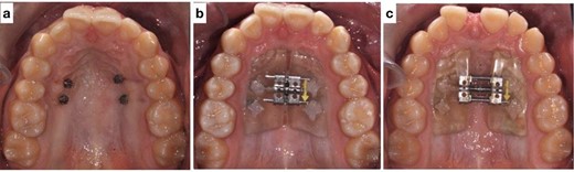 (a) Mini screws placed for the skeletally anchored rapid palatal expander. (b) Pre-expansion photo of the skeletally anchored rapid palatal expander; (c) post-expansion photo of the skeletally anchored rapid palatal expander.