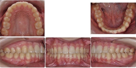 Post-treatment intra-oral photos showing severe mandibular crowding