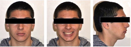 Post-treatment extra-oral photos