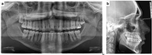 (a) Post-treatment panoramic radiograph; (b) post-treatment lateral cephalometric radiograph