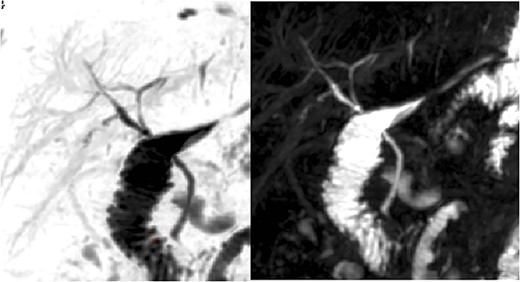 Colangio-magnetic resonance imaging with suspected variation of cystic duct insertion.