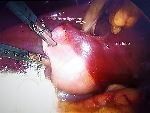 Intraoperative findings; gallbladder to the left of the falciform ligament in the left lobe.