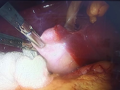 Traction of the gallbladder fundus toward the right of the falciform ligament.