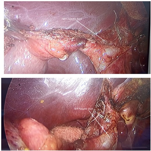 (A) Anterograde cholecystectomy, posterior cystic artery with a titanium clip; (B) Exposure of the extrahepatic biliary duct revealing anatomical variant.