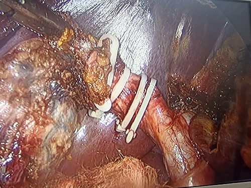 Placement of the Hem-o-lok proximal and distal to the cystic duct and its division.