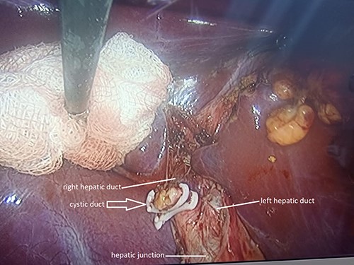 Anatomical variant of the cystic duct; drainage into the right hepatic duct.