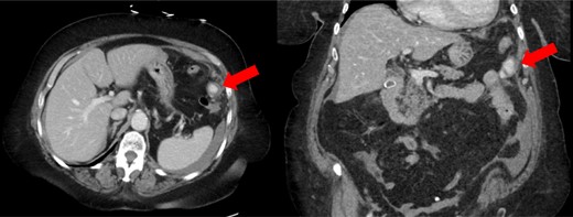CT scan showing enhancing pseudoaneurysm (red arrow) with associated hemoperitoneum around the spleen, liver, and in left the paracolic gutter.