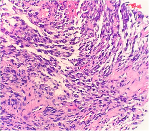 Microscopic examination reveals spindle tumor cells in sclerotic and myxoid stroma (HE stain x40).