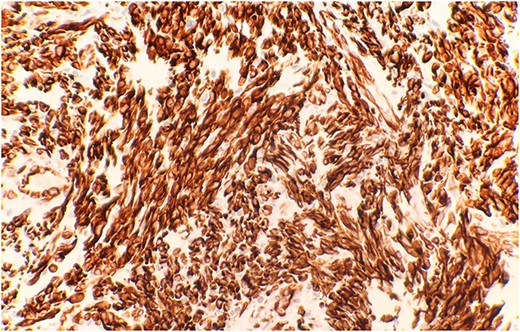 Immunohistochemical stain reveals that tumor cells are positive for WT-1 (IHC stain x40).