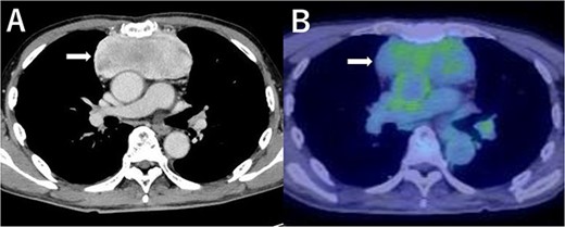 Contrast-enhanced chest CT scan (A) and FDG-PET scan (B) of the tumor (SUVmax = 3.32).